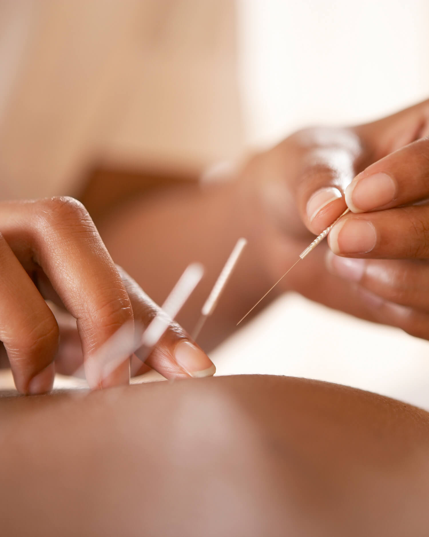 Acupuncture being applied to woman's back.