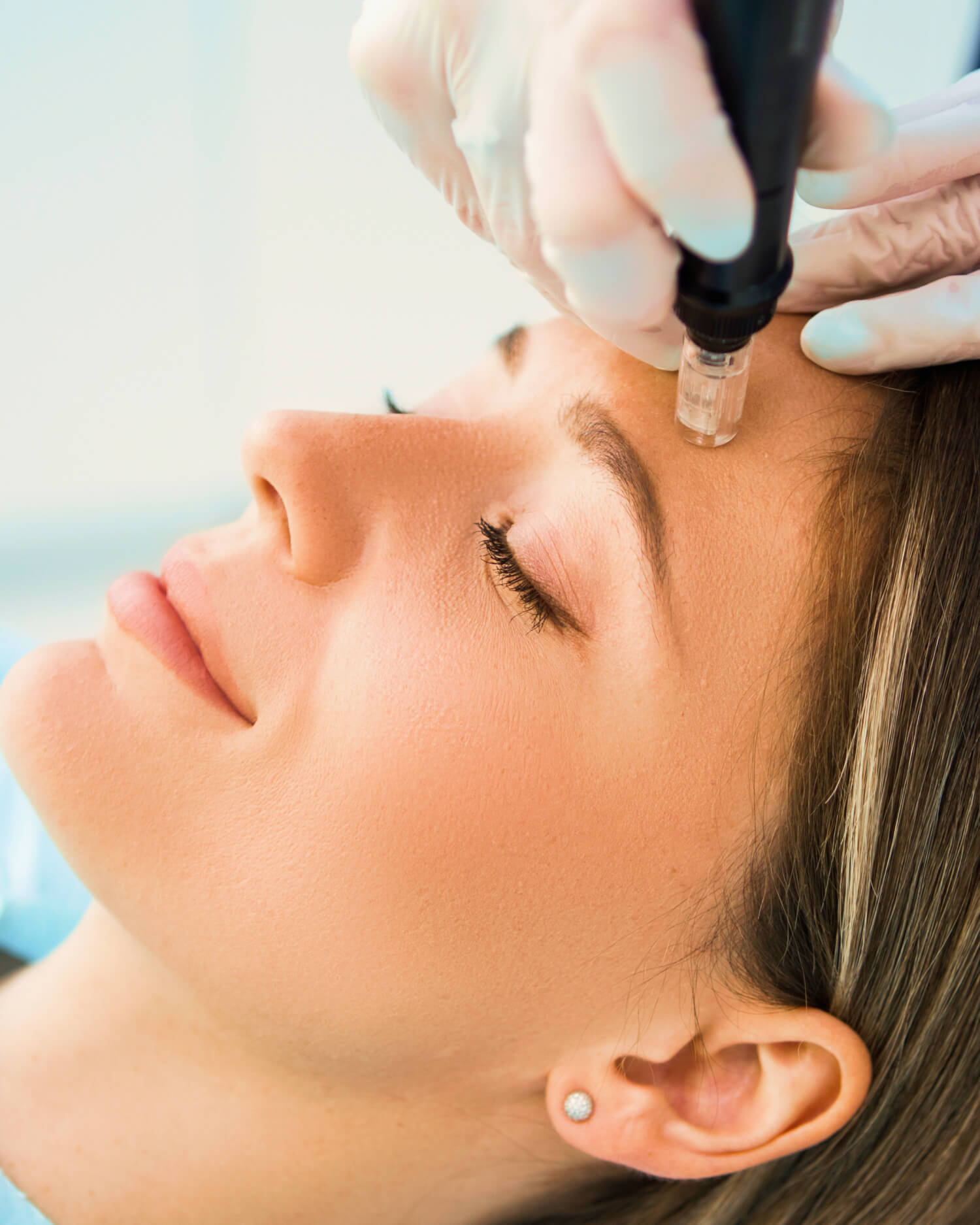 Microneedling Treatment