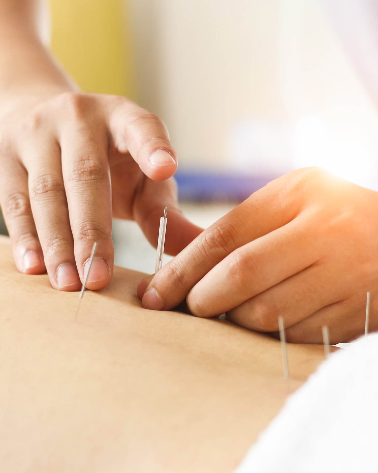 Man receiving acupuncture treatment on his arm.